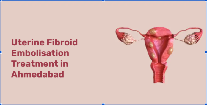Uterine Fibroid Embolisation in Ahmedabad